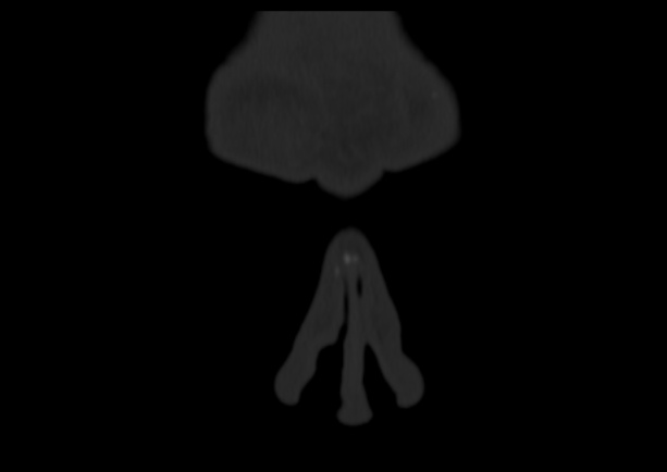 Coronal Slice 1