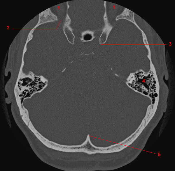 CT Skull Foramina