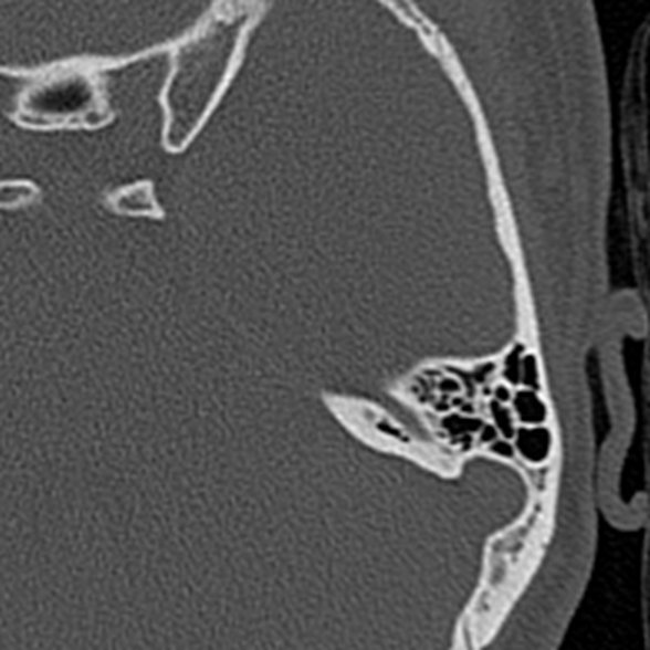 Axial CT Temporal Bone Slice